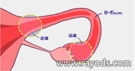 妇女必须小心，因为输卵管堵塞可能是由以下行