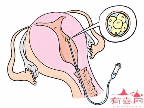 西安做试管的医院：妇女在试管婴儿期间要忍受