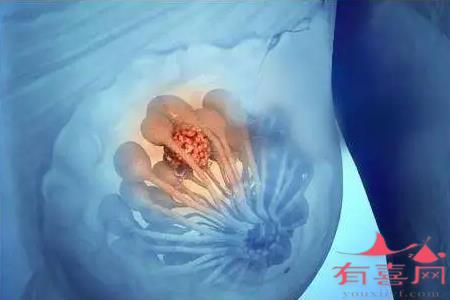 宜春59岁助孕机构：检查乳腺最准确的测试是什么